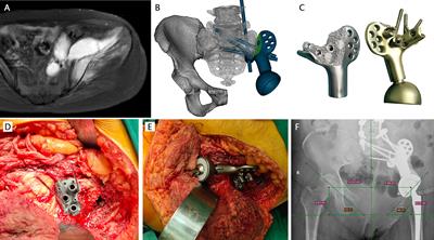 Reconstruction of Tumor-Induced Pelvic Defects With Customized, Three-Dimensional Printed Prostheses